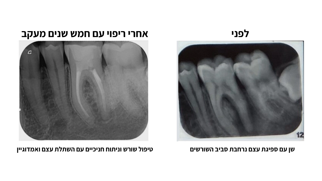 צילום לפני של רנטגן שן עם ספיגת עצם נרחבת וטיפול אחרי של ניתוח חניכיים עם השתלת עצם ואמדוגיין - תוצאה עם 5 שנות מעקב
